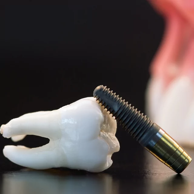 Graphic of a dental implant and tooth crown for Denver dental implants