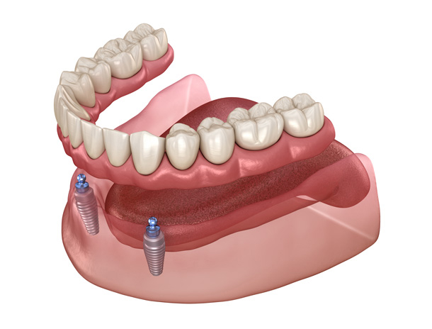 Implant supported dentures in Lone Tree diagram