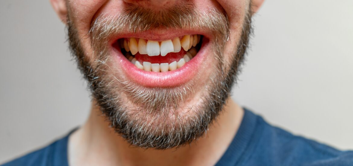 closeup of a man in a blue shirt with a chipped front tooth