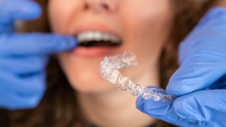 closeup of Dr. in blue gloves placing clear aligners in patients mouth