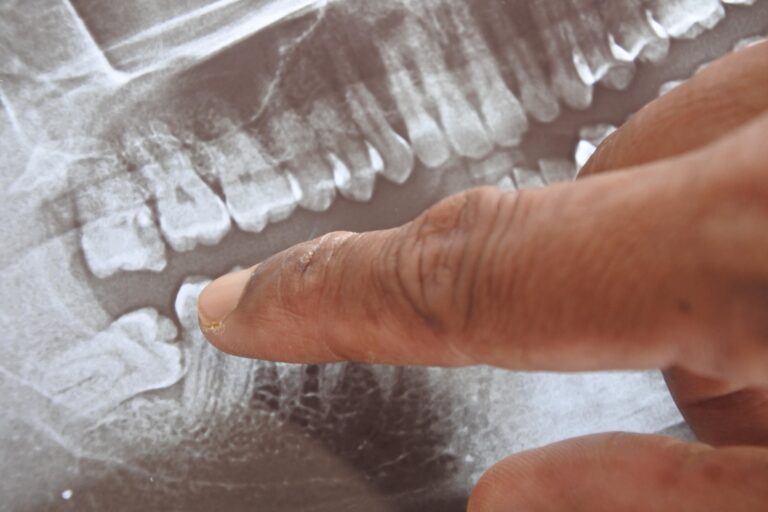 x-ray of an impacted wisdom tooth