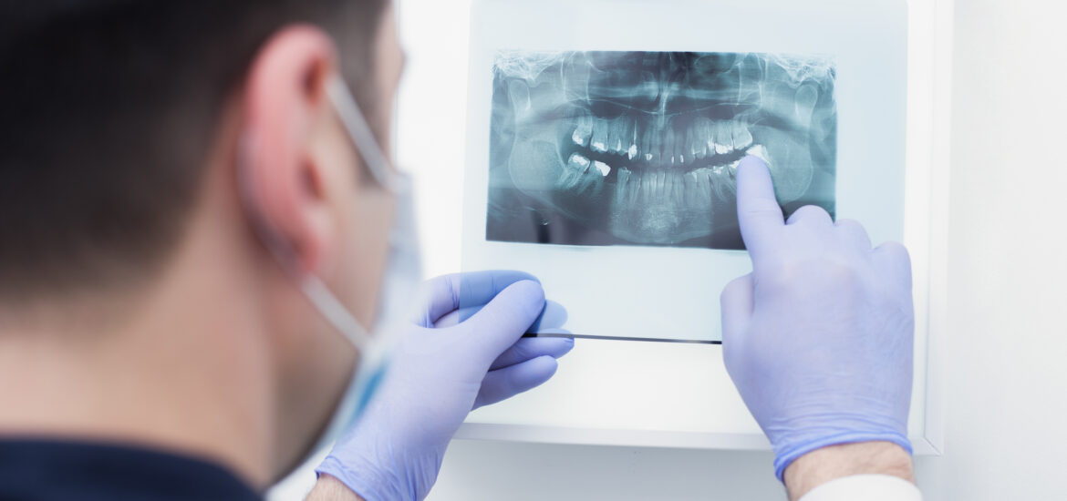 dentist pointing out impacted wisdom teeth on an x-ray