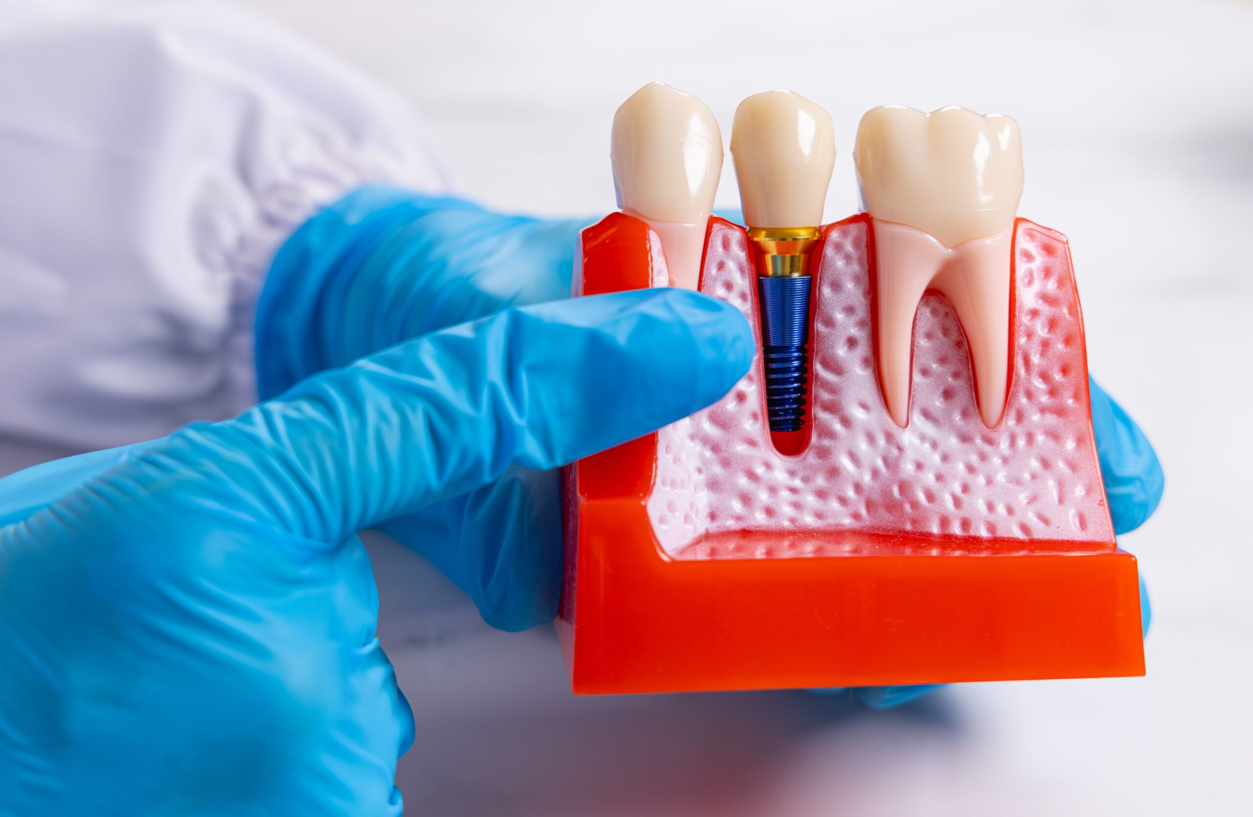 Close-up of a dentist pointing with his blue gloves at a implant model