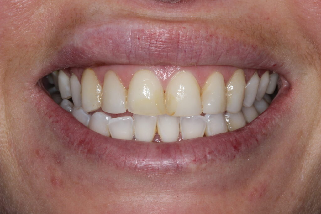Smile before 3D printed veneers, showing discolored front teeth