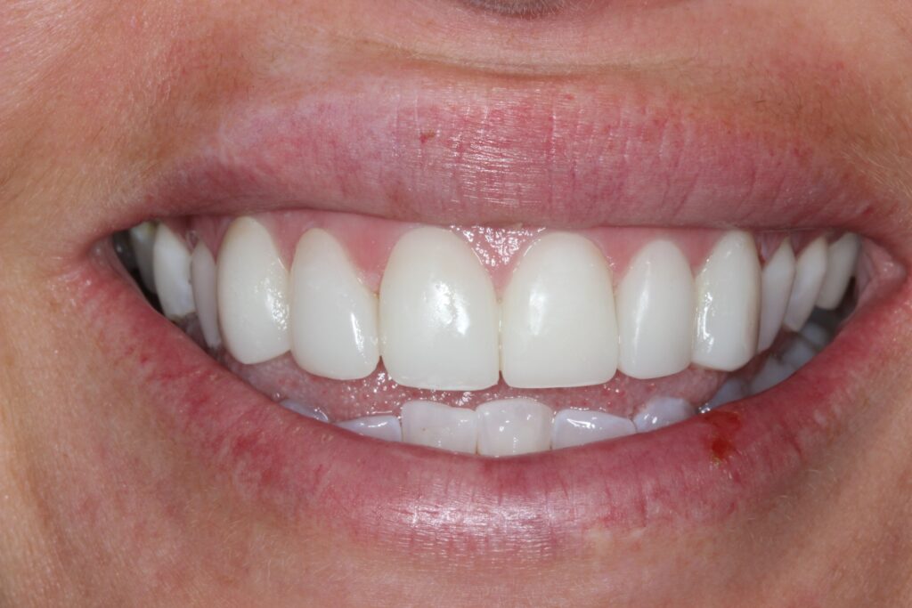 Smile after 3D printed veneers at Almeida & Bell Dental in Lone Tree