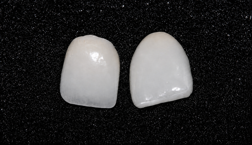 Traditional porcelain veneer next to a thinner 3D printed veneer