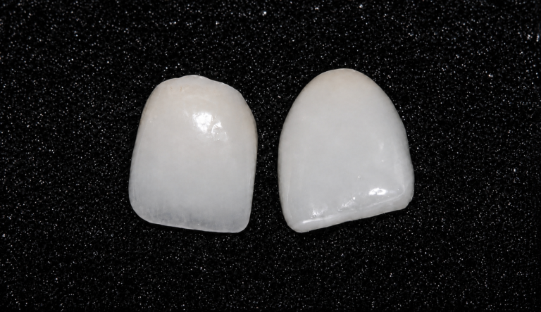 Traditional porcelain veneer next to a thinner 3D printed veneer